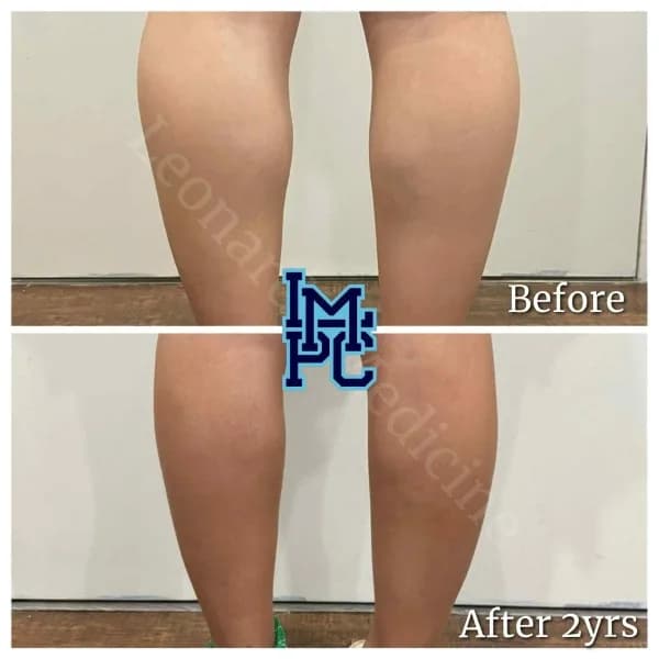 Body Tox treatment 1