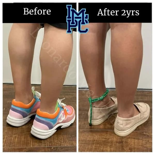 Body Tox treatment 10