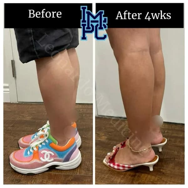 Body Tox treatment 11