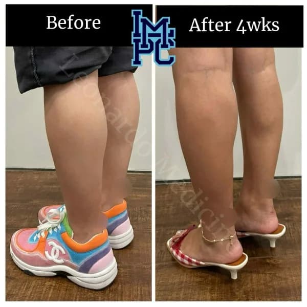 Body Tox treatment 12