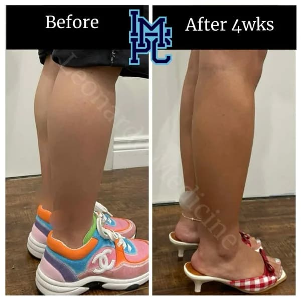 Body Tox treatment 13