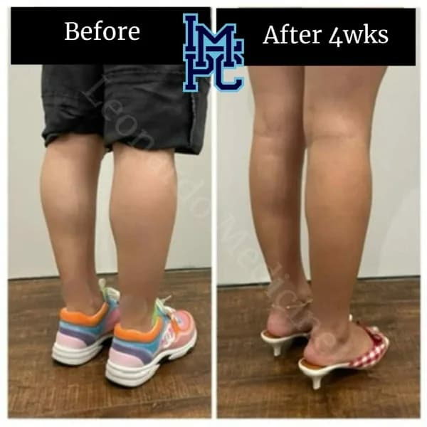 Body Tox treatment 14