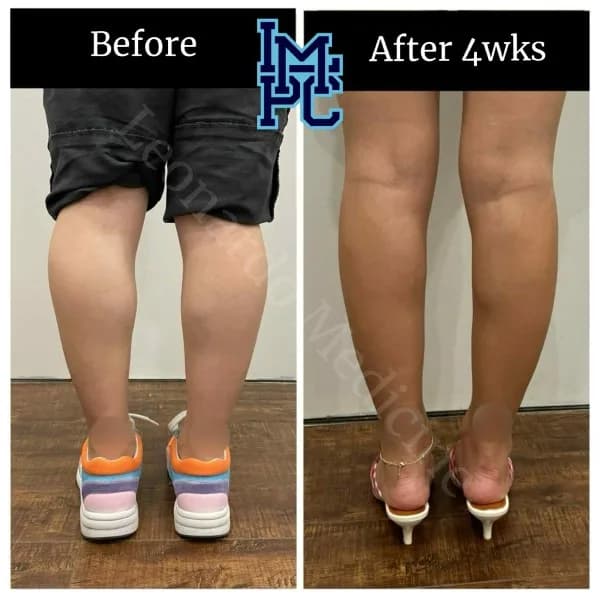 Body Tox treatment 15