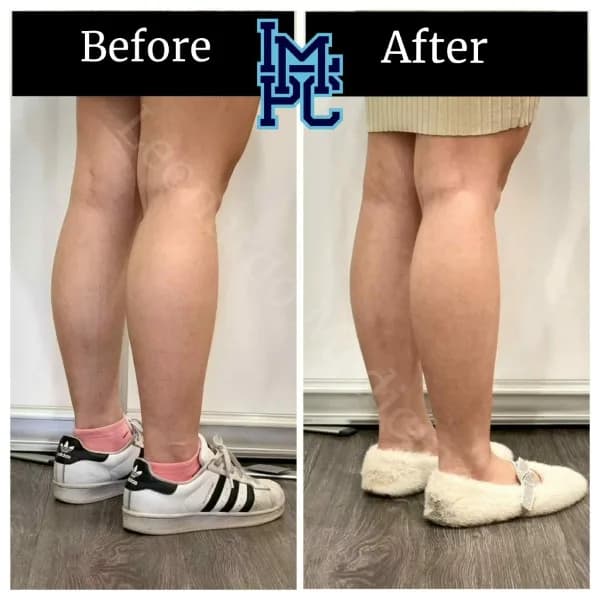 Body Tox treatment 16