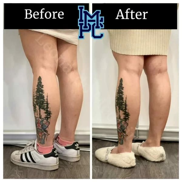 Body Tox treatment 17