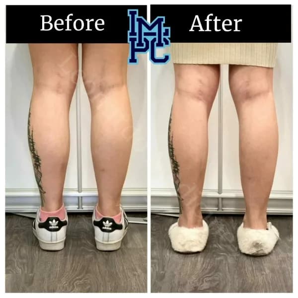 Body Tox treatment 18