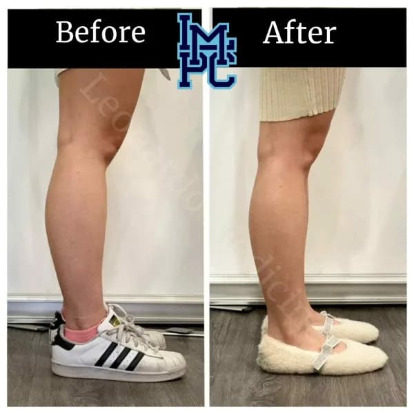 Body Tox treatment 19