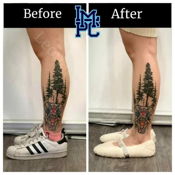 Body Tox treatment 20