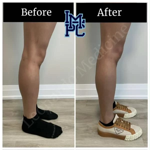 Body Tox treatment 3