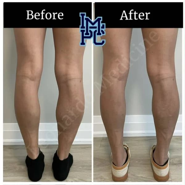 Body Tox treatment 5