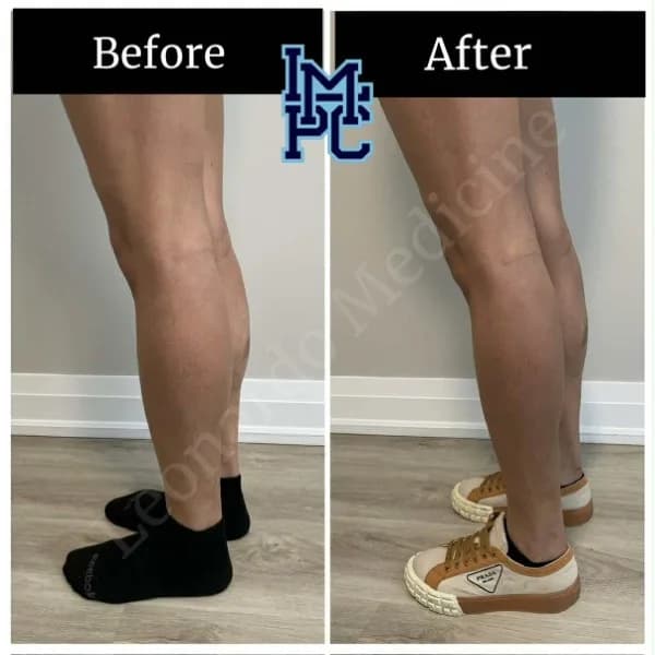 Body Tox treatment 6