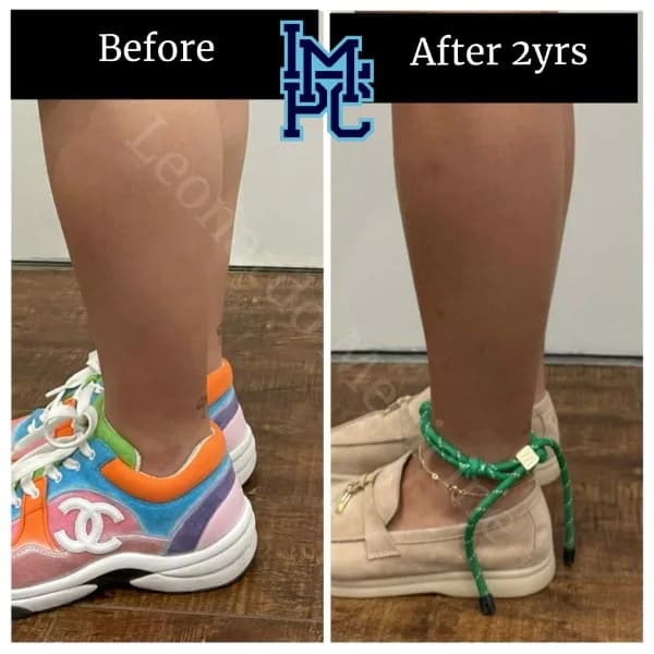 Body Tox treatment 7