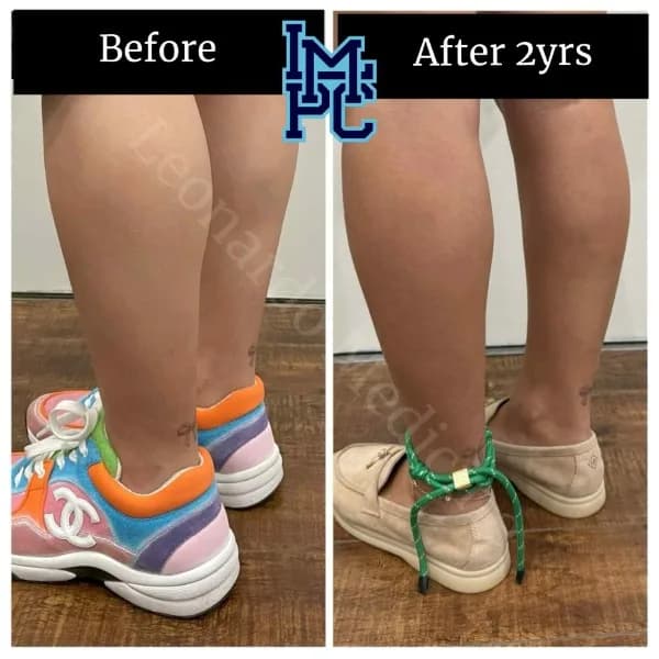 Body Tox treatment 8