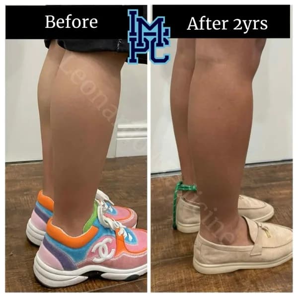 Body Tox treatment 9