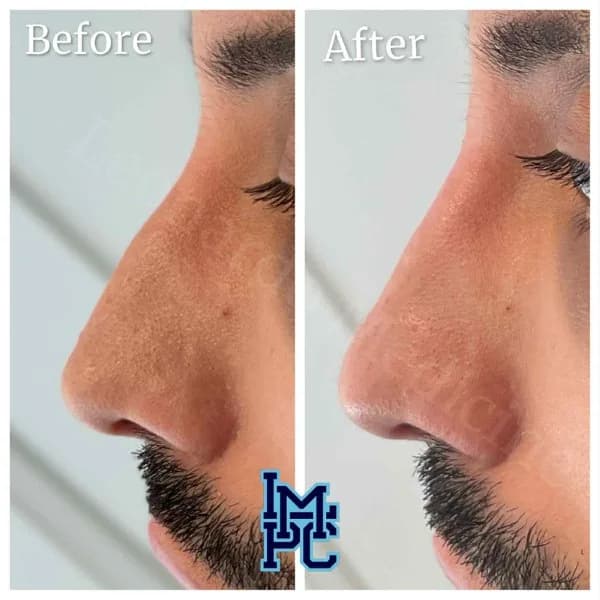 Middle Face Filler treatment 1