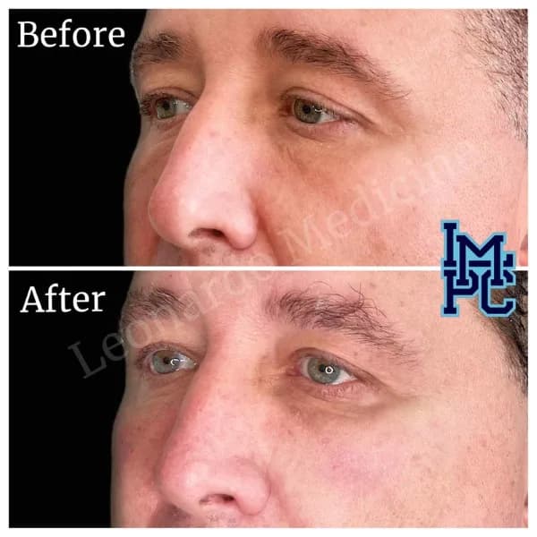 Middle Face Filler treatment 10