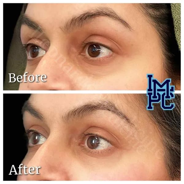 Middle Face Filler treatment 11