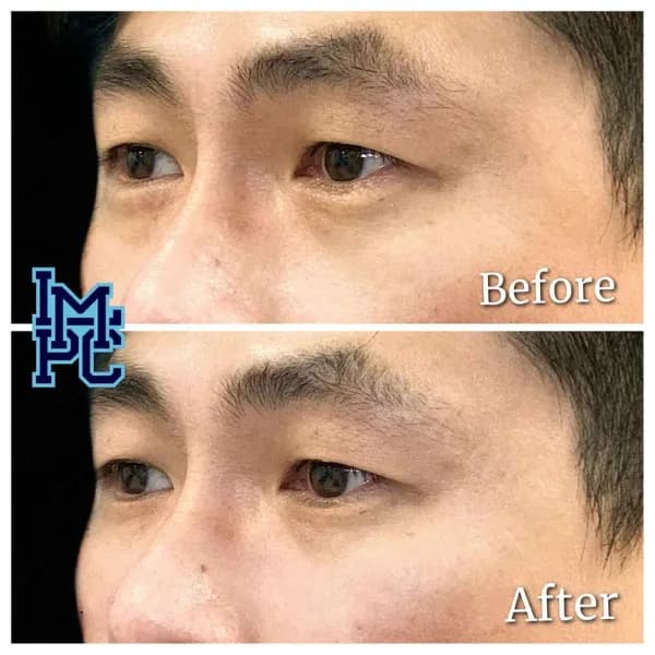 Middle Face Filler treatment 12