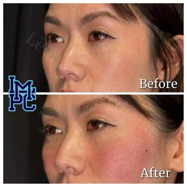 Middle Face Filler treatment 13