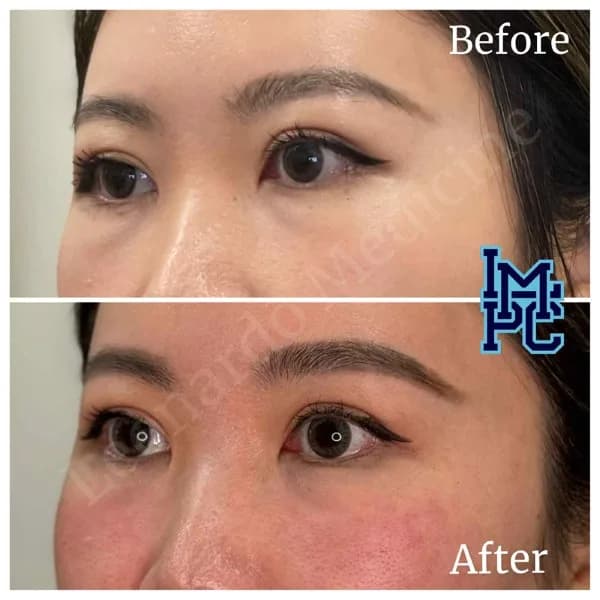 Middle Face Filler treatment 14