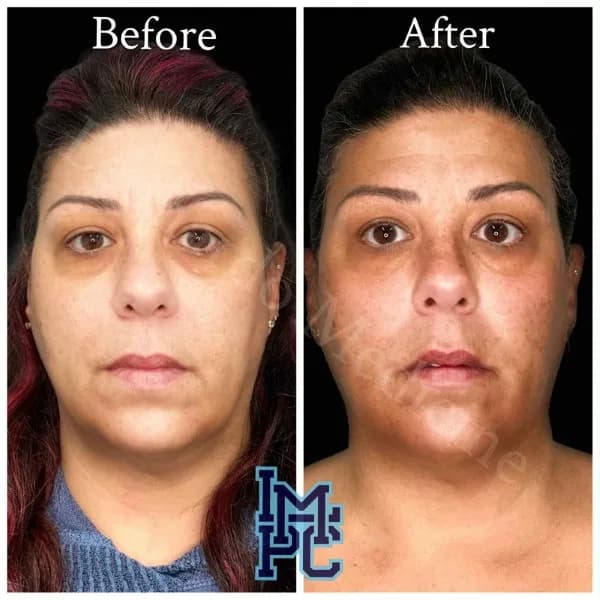 Middle Face Filler treatment 16