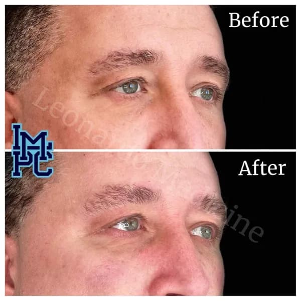 Middle Face Filler treatment 18