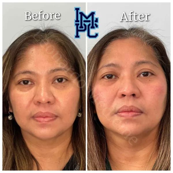 Middle Face Filler treatment 19