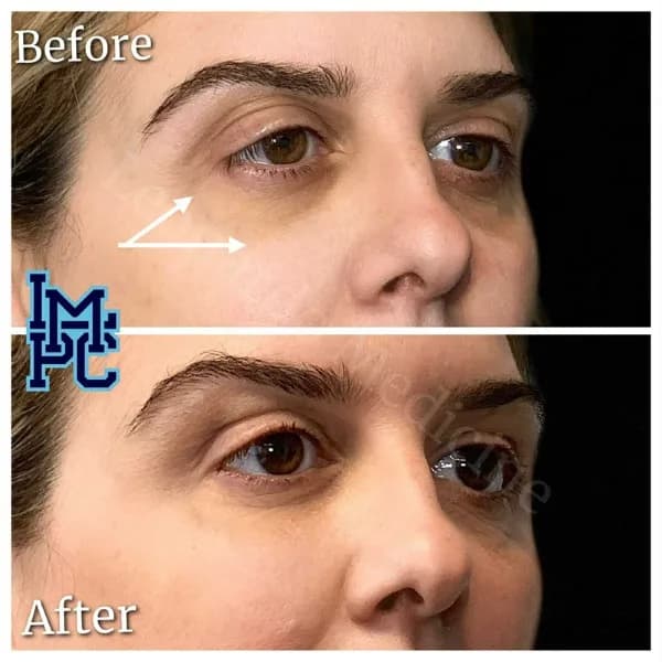 Middle Face Filler treatment 2