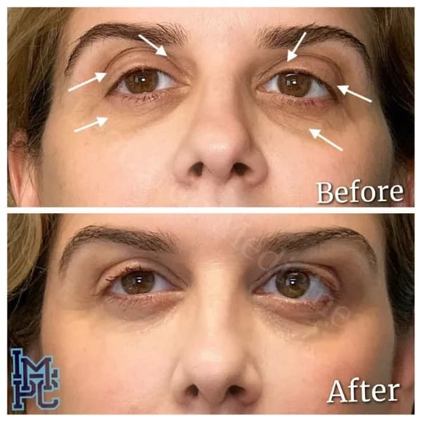 Middle Face Filler treatment 20