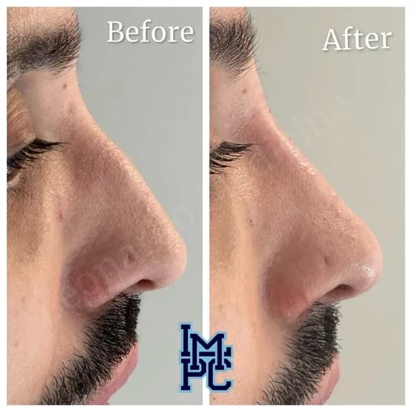 Middle Face Filler treatment 21