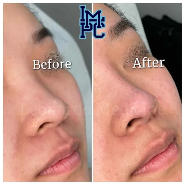 Middle Face Filler treatment 22