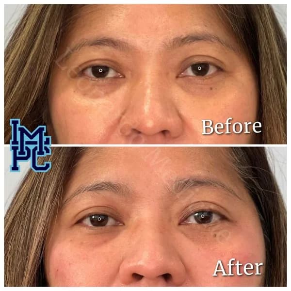 Middle Face Filler treatment 24