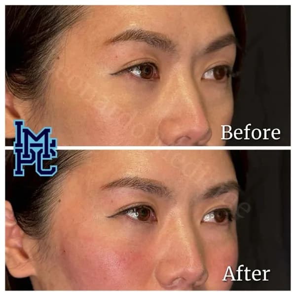 Middle Face Filler treatment 25