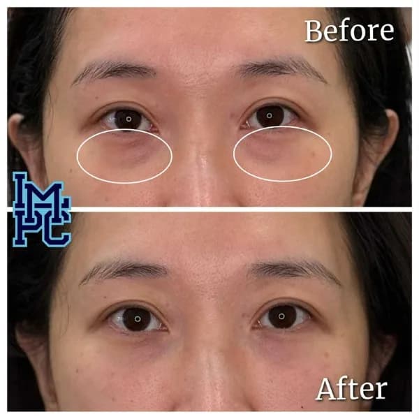 Middle Face Filler treatment 26