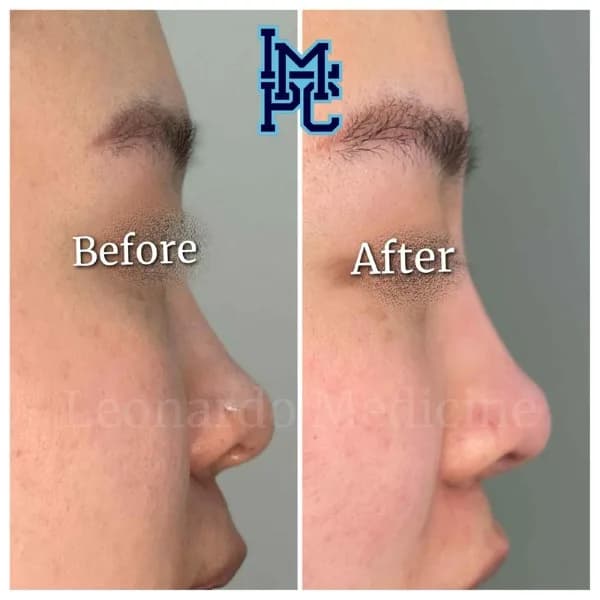 Middle Face Filler treatment 27