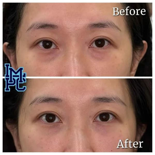 Middle Face Filler treatment 28