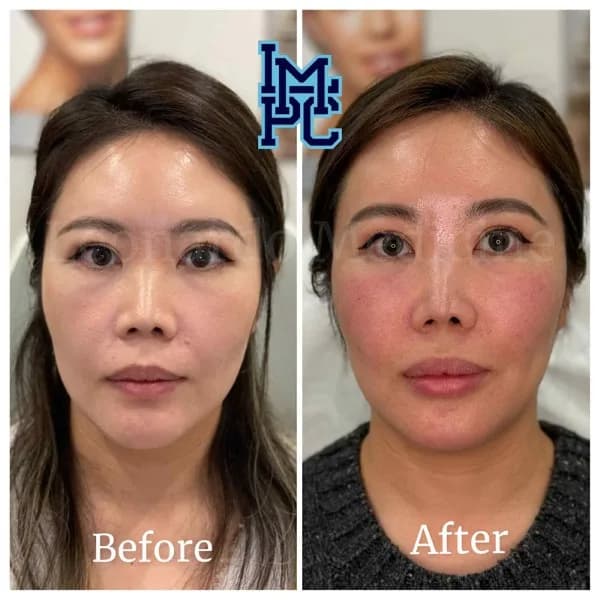 Middle Face Filler treatment 29