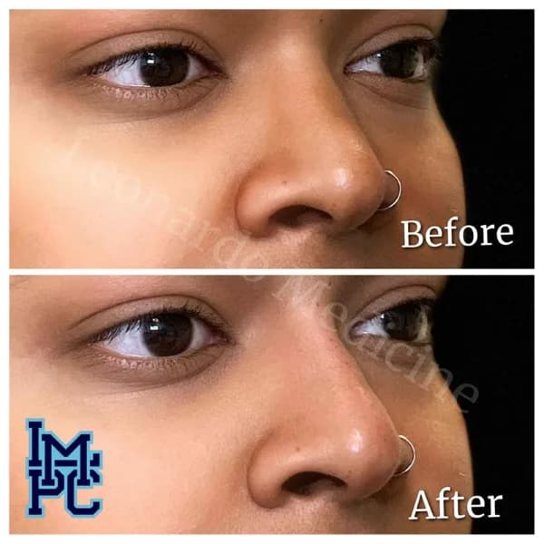Middle Face Filler treatment 3