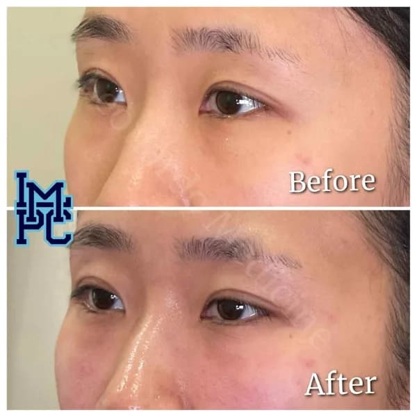 Middle Face Filler treatment 30