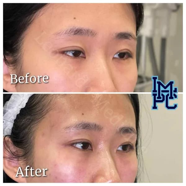 Middle Face Filler treatment 31