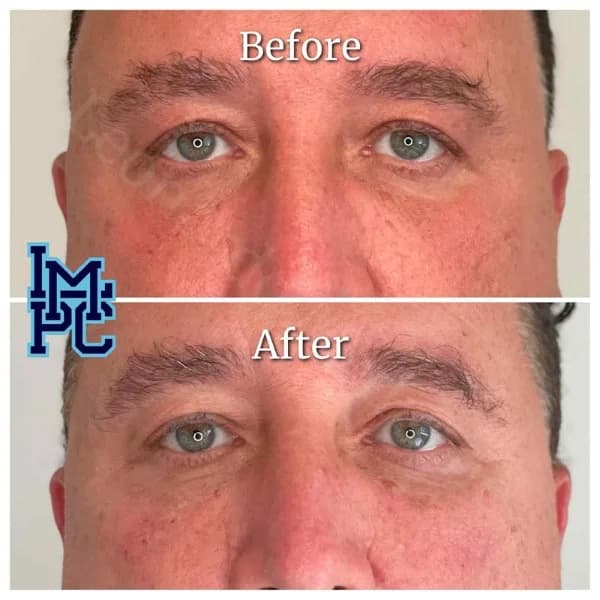 Middle Face Filler treatment 32