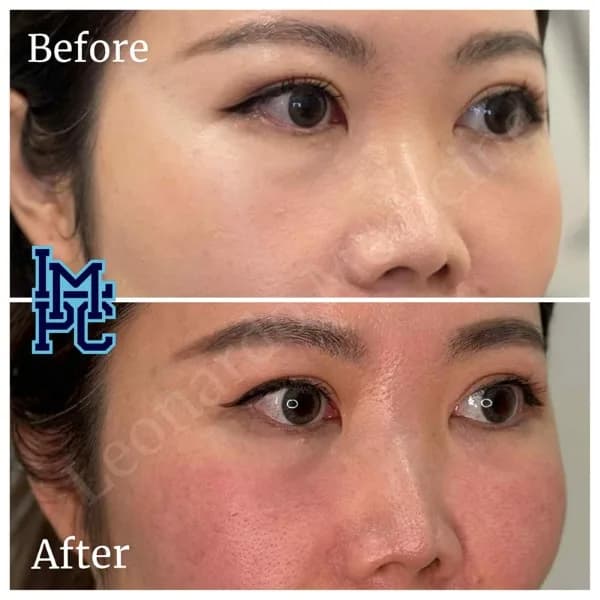 Middle Face Filler treatment 33
