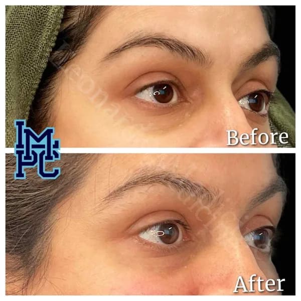 Middle Face Filler treatment 34