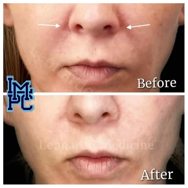 Middle Face Filler treatment 35