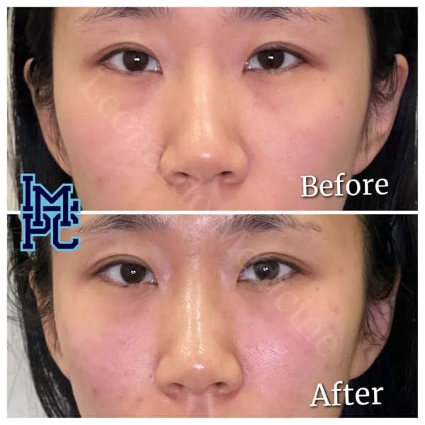 Middle Face Filler treatment 36