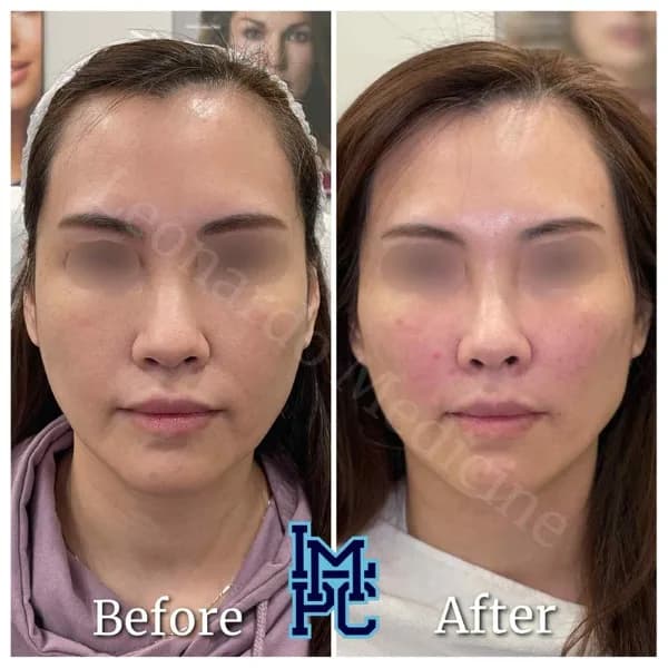 Middle Face Filler treatment 37