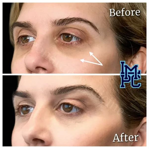 Middle Face Filler treatment 39