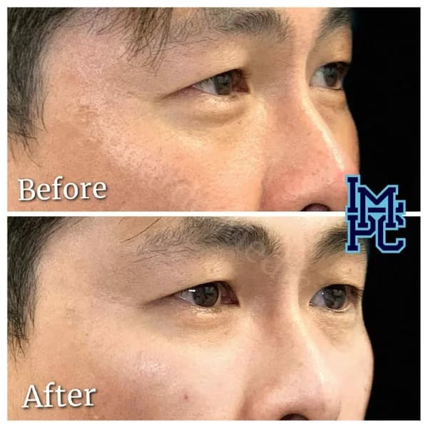Middle Face Filler treatment 4