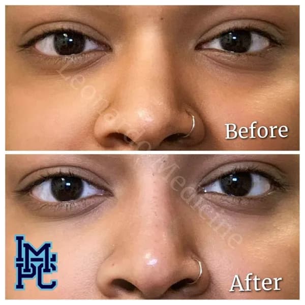 Middle Face Filler treatment 40