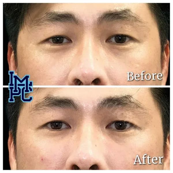 Middle Face Filler treatment 41